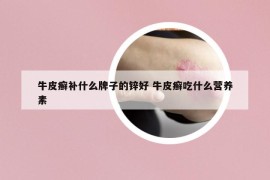 牛皮癣补什么牌子的锌好 牛皮癣吃什么营养素