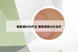 银屑病火针疗法 银屑病用火针治疗
