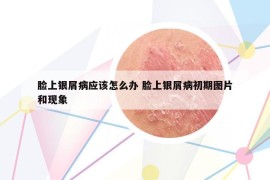 脸上银屑病应该怎么办 脸上银屑病初期图片和现象