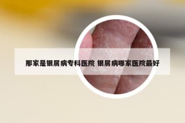 那家是银屑病专科医院 银屑病哪家医院最好