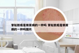 掌趾脓疱是银屑病的一种吗 掌趾脓疱是银屑病的一种吗图片