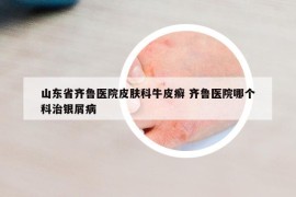 山东省齐鲁医院皮肤科牛皮癣 齐鲁医院哪个科治银屑病