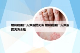 银屑病用什么沐浴露洗澡 银屑病用什么沐浴露洗澡合适
