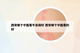 西安哪个中医看牛皮癣好 西安哪个中医看的好