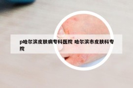 p哈尔滨皮肤病专科医院 哈尔滨市皮肤科专院