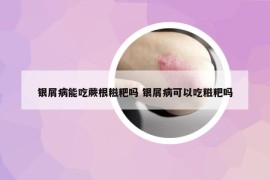 银屑病能吃蕨根糍粑吗 银屑病可以吃糍粑吗