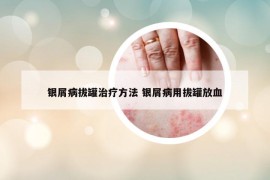 银屑病拔罐治疗方法 银屑病用拔罐放血