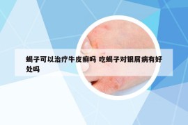 蝎子可以治疗牛皮癣吗 吃蝎子对银屑病有好处吗