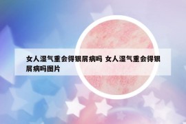 女人湿气重会得银屑病吗 女人湿气重会得银屑病吗图片