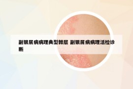 副银屑病病理典型棘层 副银屑病病理活检诊断