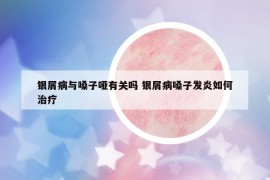 银屑病与嗓子哑有关吗 银屑病嗓子发炎如何治疗