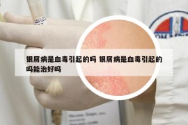 银屑病是血毒引起的吗 银屑病是血毒引起的吗能治好吗