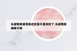 头部银屑病发痒迟皮是不是快好了 头部银屑病痒不痒