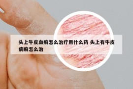 头上牛皮血癣怎么治疗用什么药 头上有牛皮病癣怎么治