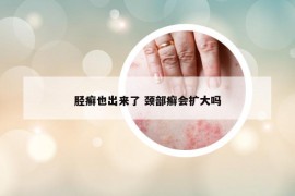胫癣也出来了 颈部癣会扩大吗