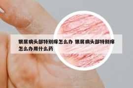 银屑病头部特别痒怎么办 银屑病头部特别痒怎么办用什么药