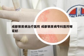 成都银屑病治疗医院 成都银屑病专科医院哪家好
