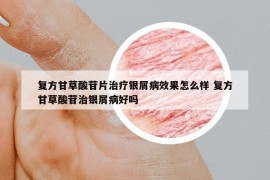 复方甘草酸苷片治疗银屑病效果怎么样 复方甘草酸苷治银屑病好吗