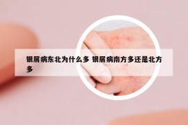 银屑病东北为什么多 银屑病南方多还是北方多