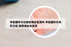 甲氨蝶呤不吃银屑病会复发吗 甲氨蝶呤片停药之后,银屑病全身复发