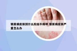 银屑病皮损到什么阶段不痒啊 银屑病皮损严重怎么办