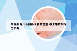 牛皮癣为什么到春天就会加重 春天牛皮癣痒怎么办