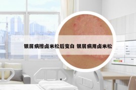 银屑病擦卤米松后变白 银屑病用卤米松