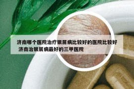 济南哪个医院治疗银屑病比较好的医院比较好 济南治银屑病最好的三甲医院