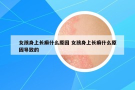 女孩身上长癣什么原因 女孩身上长癣什么原因导致的