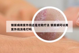 银屑病用紫外线还是光敏疗法 银屑病可以用紫外线消毒灯吗