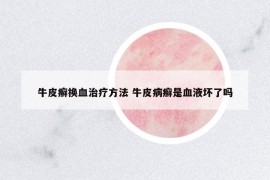 牛皮癣换血治疗方法 牛皮病癣是血液坏了吗