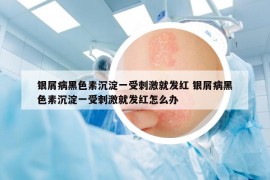 银屑病黑色素沉淀一受刺激就发红 银屑病黑色素沉淀一受刺激就发红怎么办