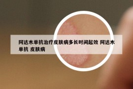 阿达木单抗治疗皮肤病多长时间起效 阿达木单抗 皮肤病