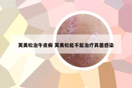 芙美松治牛皮癣 芙美松能不能治疗真菌感染