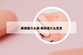 癣病是什么病 癣症是什么意思