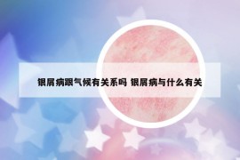 银屑病跟气候有关系吗 银屑病与什么有关