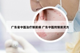 广东省中医治疗银屑病 广东中医院银屑灵方