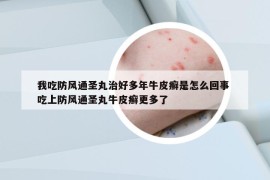 我吃防风通圣丸治好多年牛皮癣是怎么回事 吃上防风通圣丸牛皮癣更多了