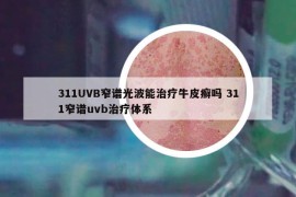 311UVB窄谱光波能治疗牛皮癣吗 311窄谱uvb治疗体系