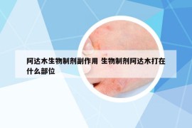 阿达木生物制剂副作用 生物制剂阿达木打在什么部位