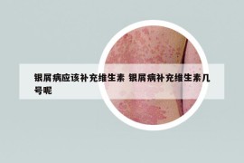银屑病应该补充维生素 银屑病补充维生素几号呢