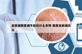 皮肤病银屑病不能吃什么食物 银屑皮肤病忌口