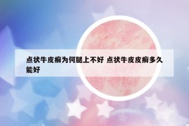 点状牛皮癣为何腿上不好 点状牛皮皮癣多久能好