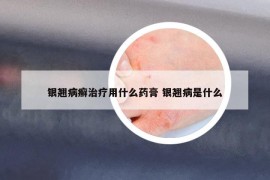 银翘病癣治疗用什么药膏 银翘病是什么