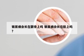 银屑病会长在颧骨上吗 银屑病会长在脸上吗?