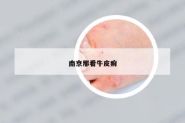 南京那看牛皮癣