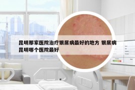 昆明那家医院治疗银屑病最好的地方 银屑病昆明哪个医院最好