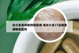 白介素类抑制剂银屑病 用白介素17治银屑病哪些医院
