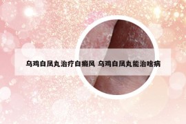 乌鸡白凤丸治疗白癜风 乌鸡白凤丸能治啥病