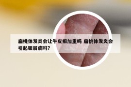 扁桃体发炎会让牛皮癣加重吗 扁桃体发炎会引起银屑病吗?